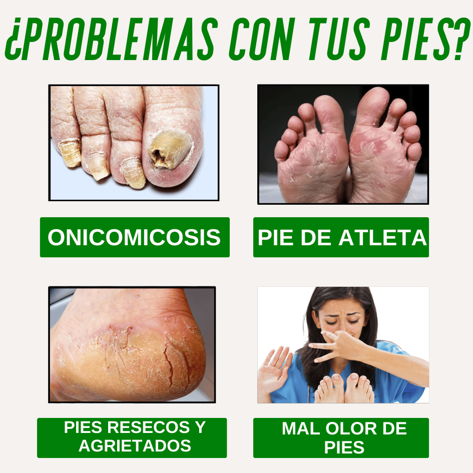 Pies Sanos❤️ Gotas Nogaderm + Crema Nogaderm de regalo  +❤️Guía digital de Bienestar de regalo